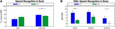 Cochlear Implant and Hearing Aid: Objective Measures of Binaural Benefit